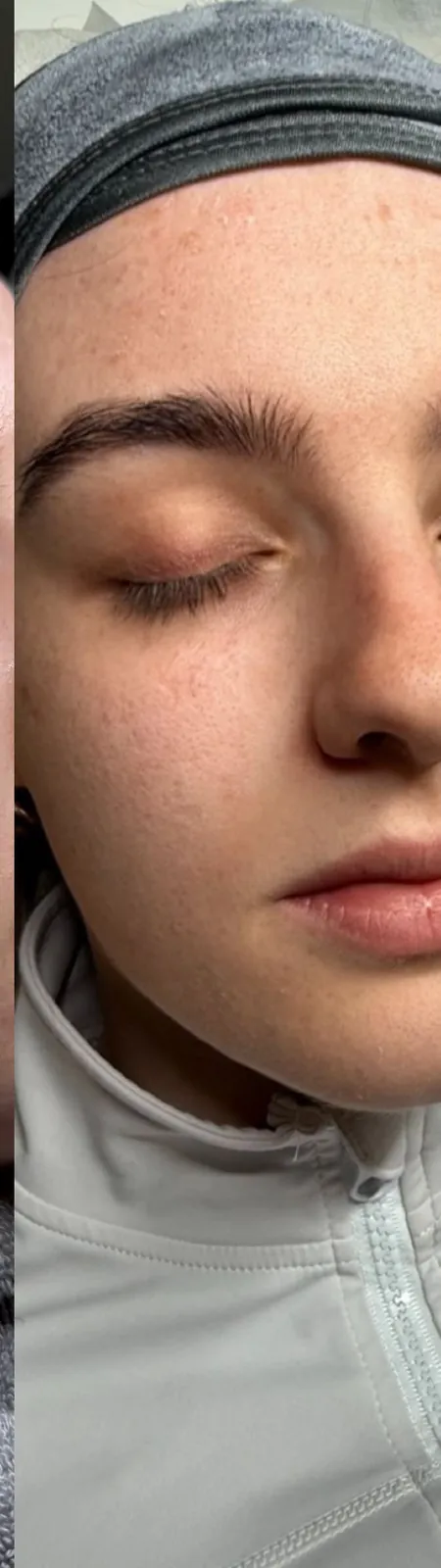 More even skin after treatment